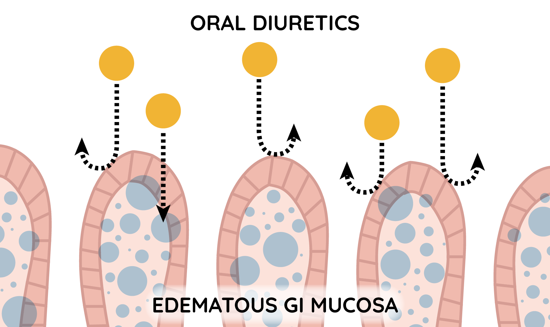 Oral diuretics are prevented from being successfully absorbed into edematous GI mucosa